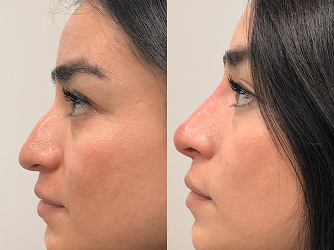 CARRUSEL ANTESY DESPUES 01