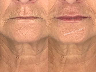 CARRUSEL ANTESY DESPUES 02