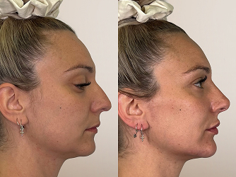 CARRUSEL ANTESY DESPUES 03