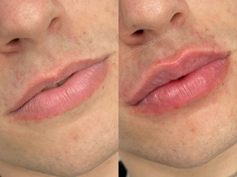 CARRUSEL ANTESY DESPUES 05