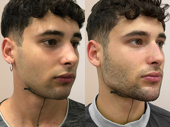 CARRUSEL ANTESY DESPUES 06